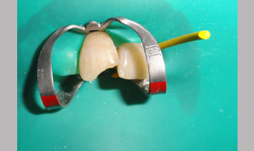 cosmetic dentistry treatment in Anand
                        